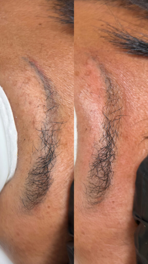 Another example of a removal