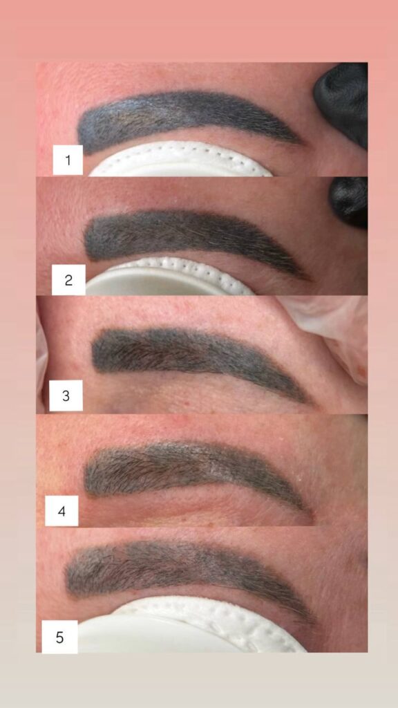 Before and after PMU brow removal results