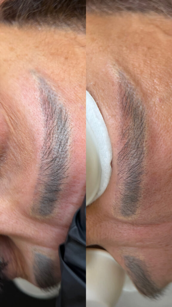 Laser PMU brow removal treatment in Carmel Indiana